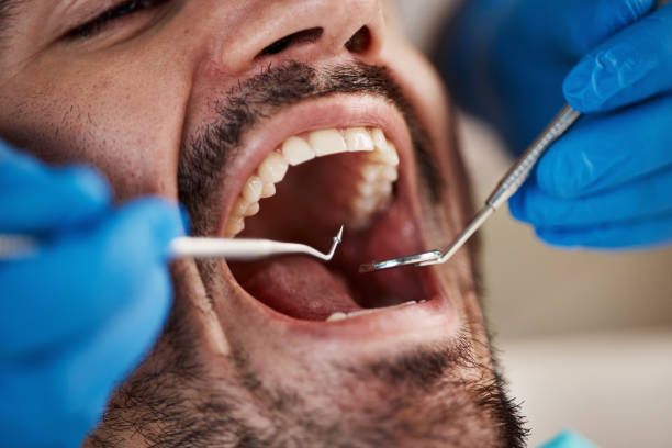 Best Emergency Tooth Extraction in Pinehurst, MA