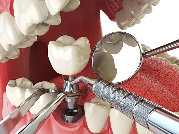 Best Emergency Denture Repair in Pinehurst, MA